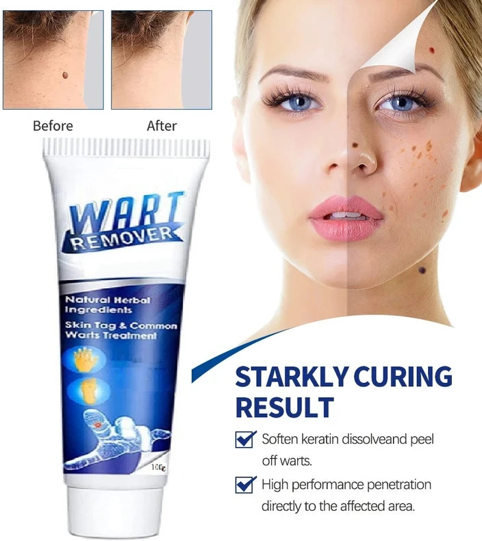 Wart Remover Gel