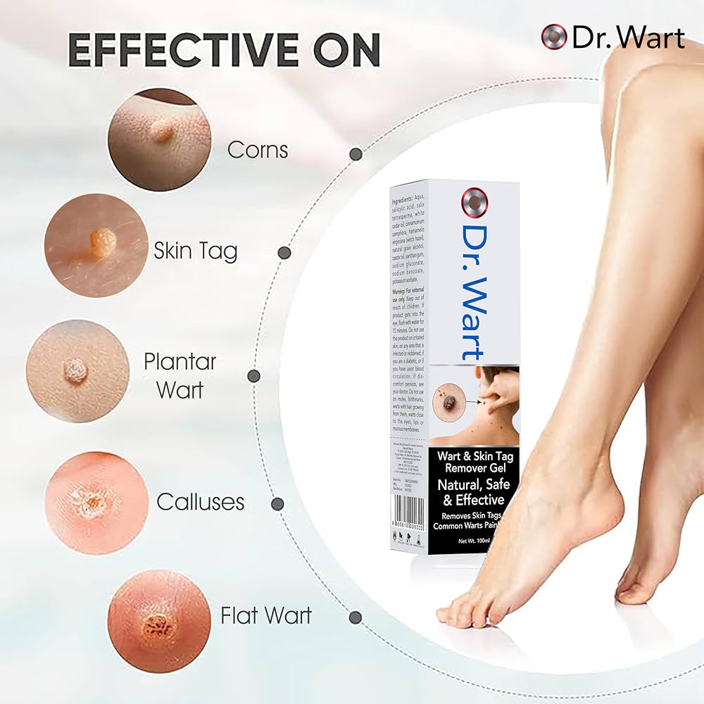 Wart Remover Gel