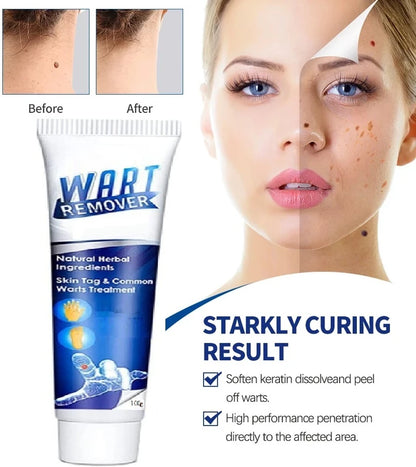 Wart Remover Gel